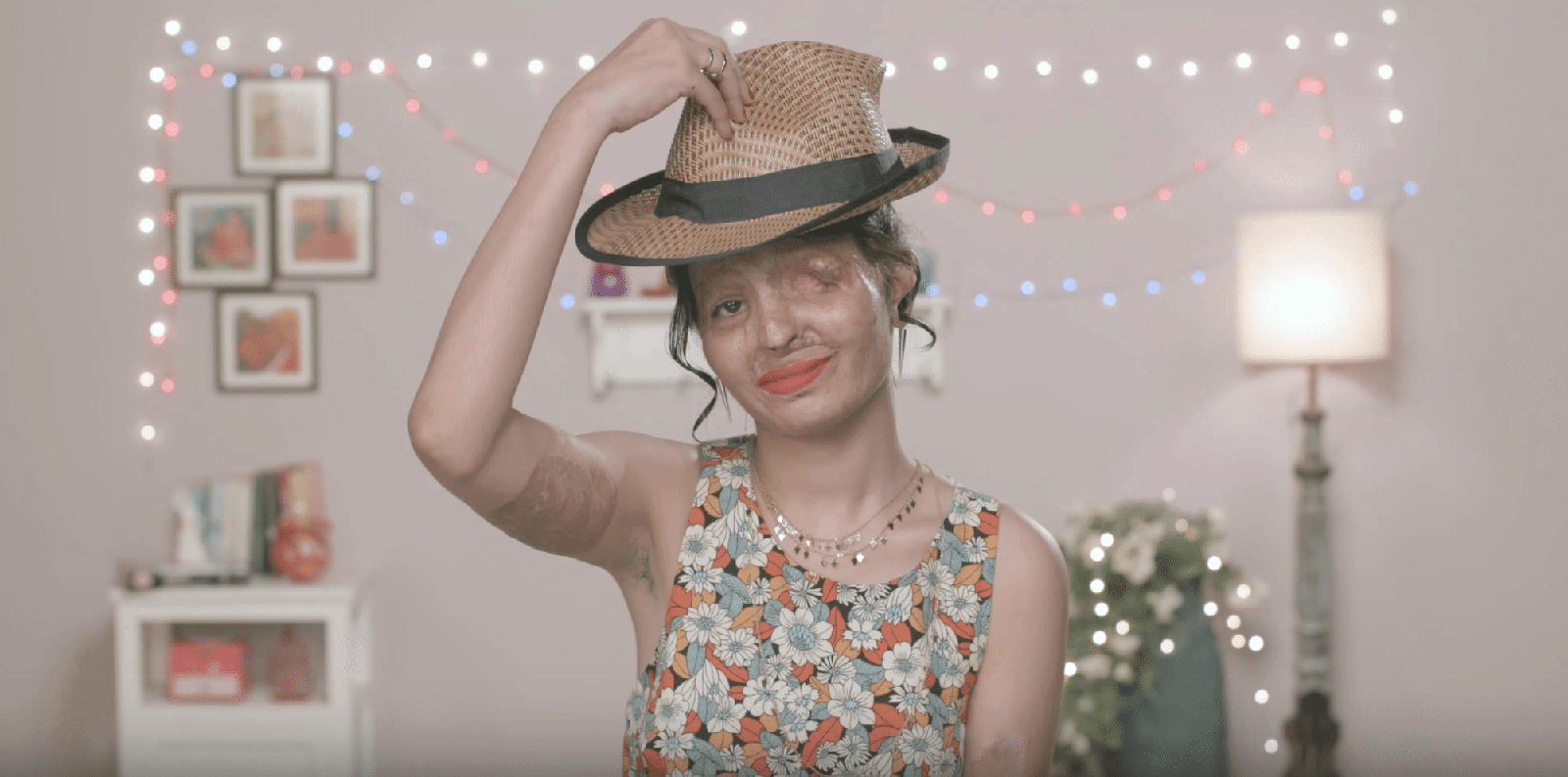 Acid attack survivor and advocate, Reshma Qureshi, offers an "if-all-else-fails" suggestion to cover up dark spots: wear a hat.